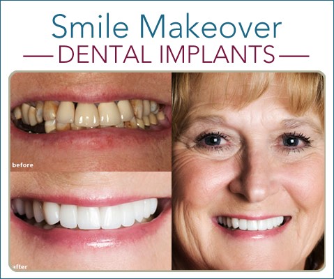 Dentures Implants Southside TN 37171